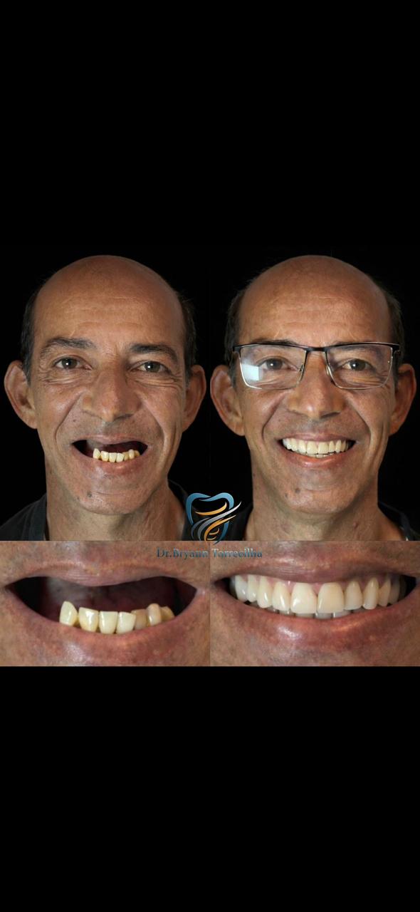 Resultado de tratamento — paciente 3